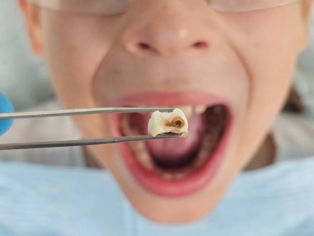 Best Broken or Chipped Tooth Repair in Inesville, GA